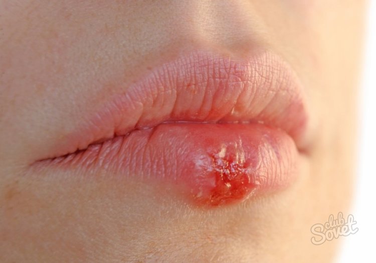 Как не заразиться герпесом