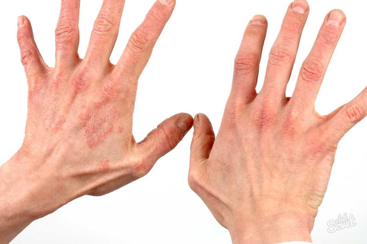атопический дерматит на кистях рук