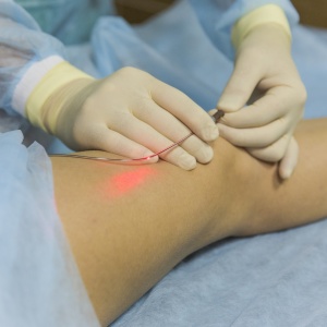 trattamento laser endovenoso