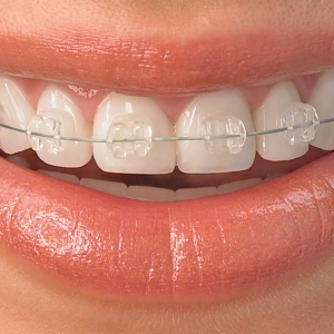ფოტო როგორ ფუნჯი კბილები braces