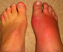 Рожистое воспаление ноги – симптомы и лечение