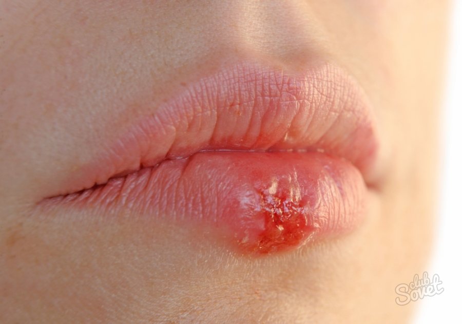 How not to get infected with herpes