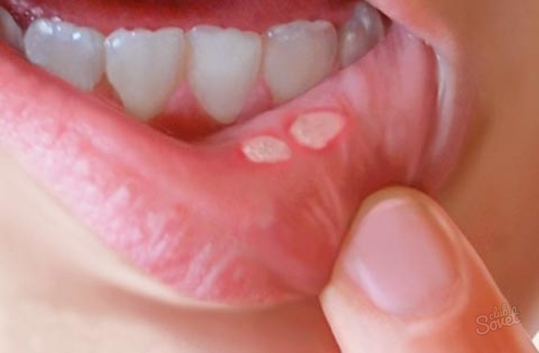 Hogyan kell kezelni a fekélyeket a szájban
