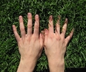 კონუსები თითების - Hygromy