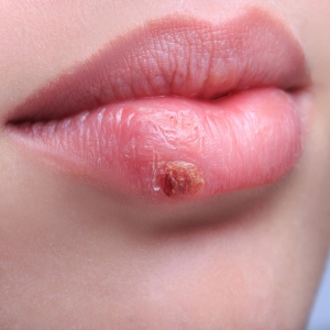 Fotografija kako brzo izliječiti herpes na usnama