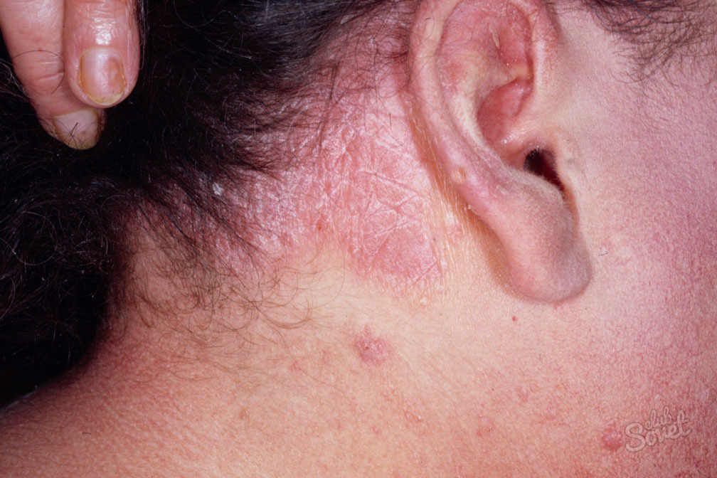 التهاب الجلد السهمي على الوجه، وكيفية علاج