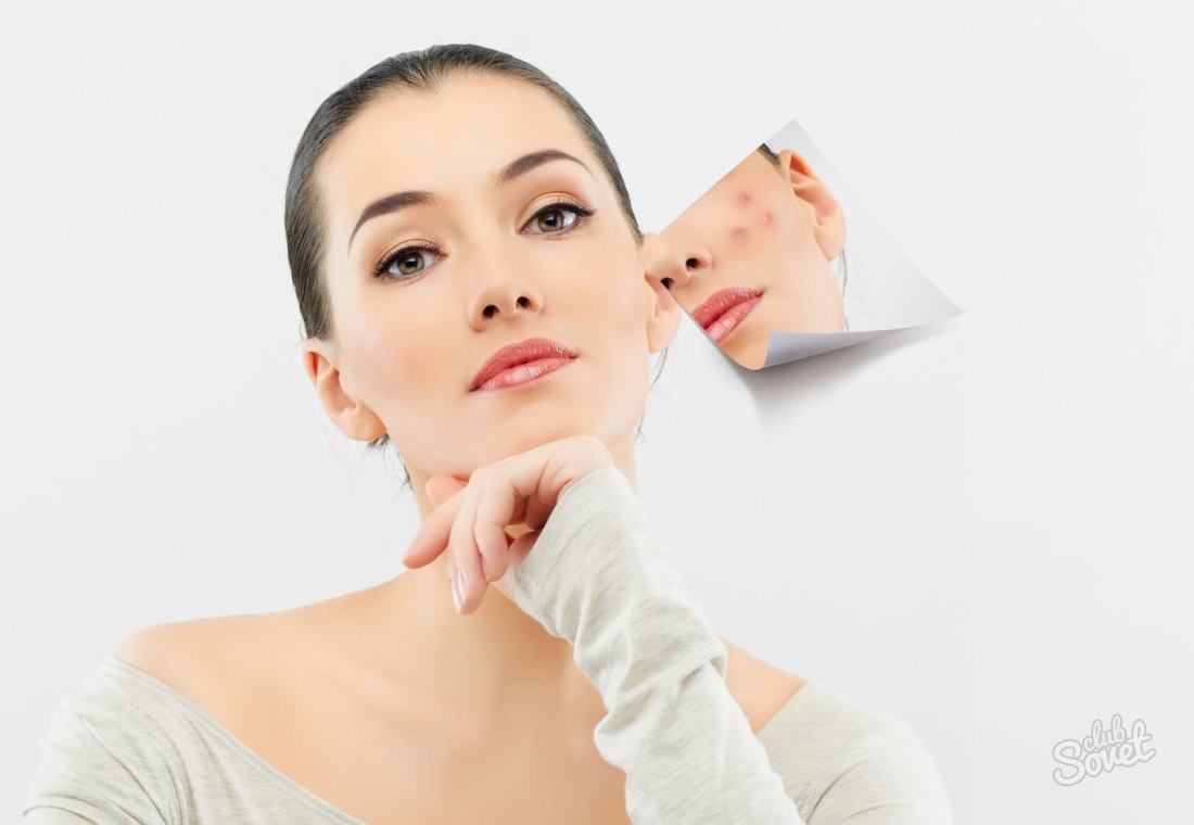 Kako se riješiti acne za 1 dan