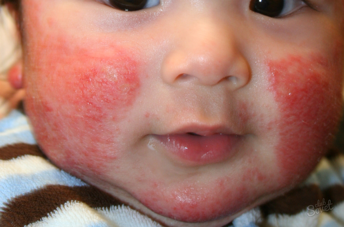 Hur man behandlar atopisk dermatit