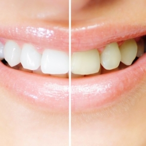 Fotografia de Stock Gel de clareamento para dentes - verdadeiro ou mito