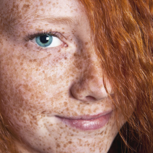 როგორ ამოიღონ freckles