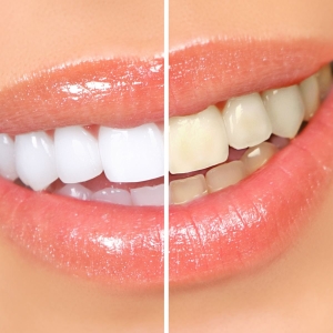 Bilder av några hemmetoder Du kan inte vita dina tänder