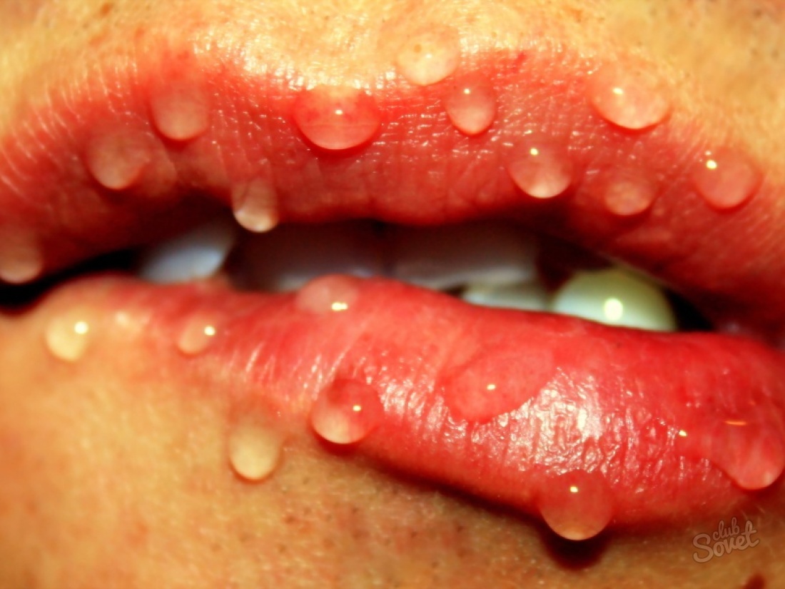 Yazovka v ústach: Ako liečiť