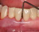 Ako liečiť periodontálne ochorenie