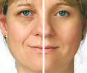 Face massage against wrinkles