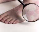 How to treat psoriasis by folk remedies