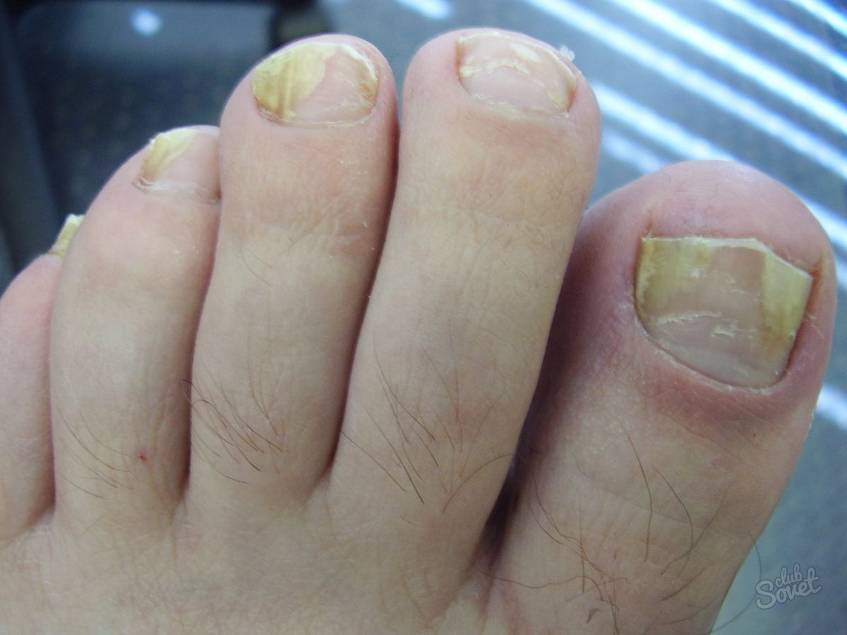 How to cure nail fungus on legs