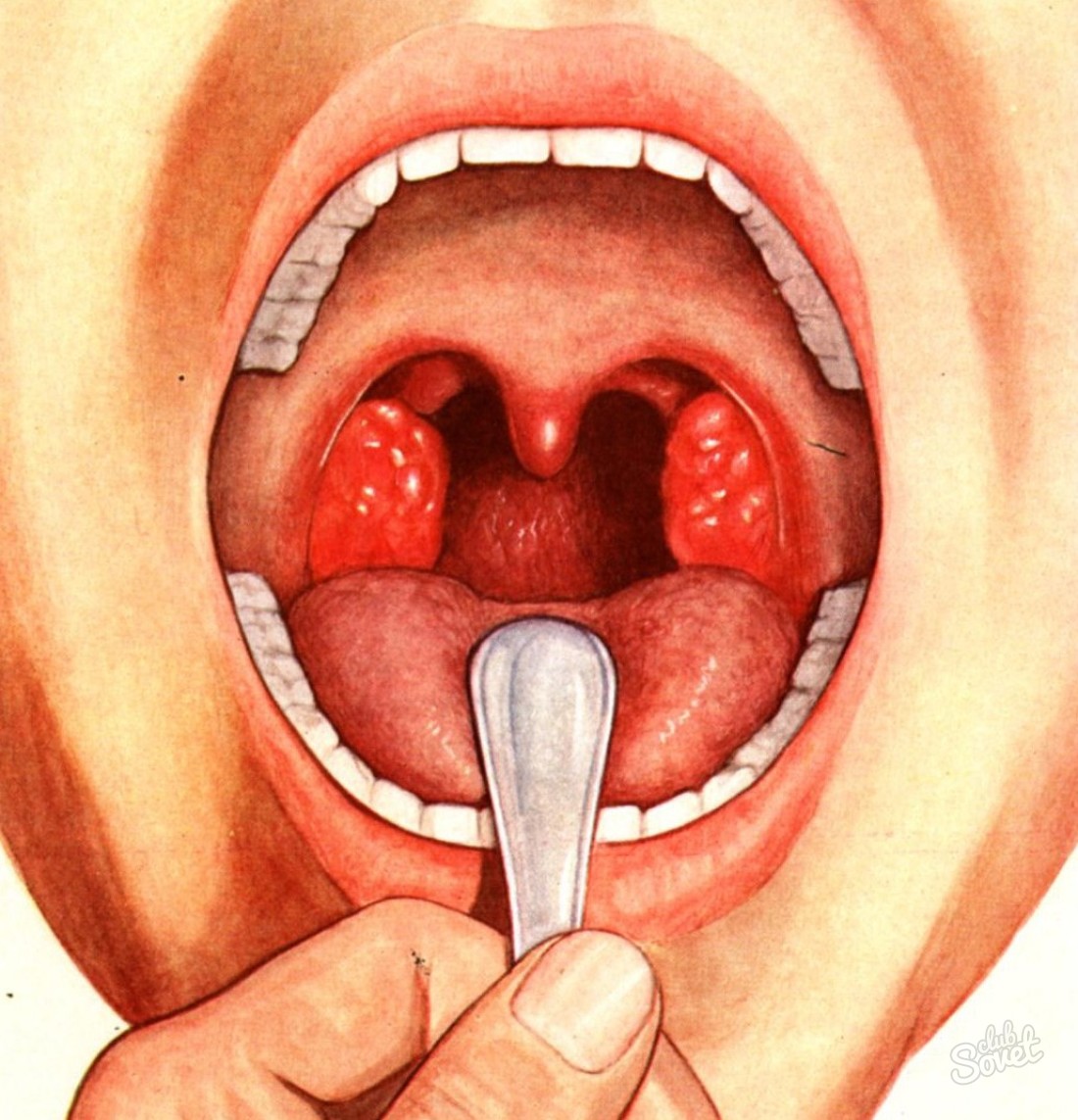 Penyakit adalah gejala tonsilitis Radang Amandel