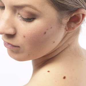 How to remove moles from face