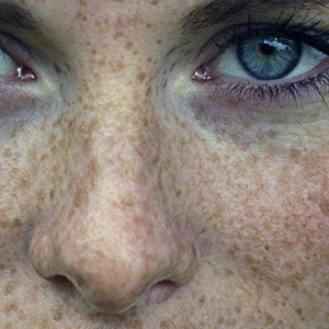 Stock Foto Pigment spots on face - causes and treatment