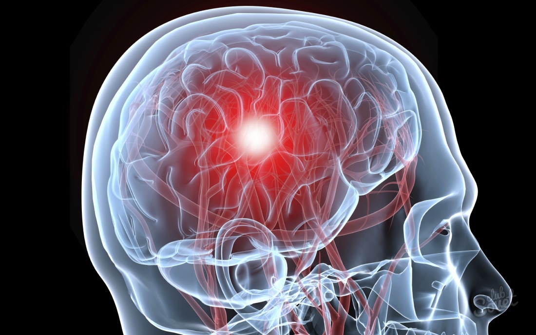 Causas e prevenção do acidente vascular cerebral