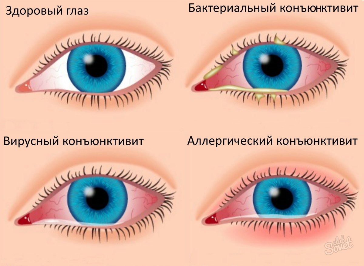 Текут глаза при простуде. Аденовирусная инфекция бактериальный конъюнктивит. Аденовирусный конъюнктивит глаз. Бактериальный конъюнктивит Гнойный. Герпетический вирусный конъюнктивит.
