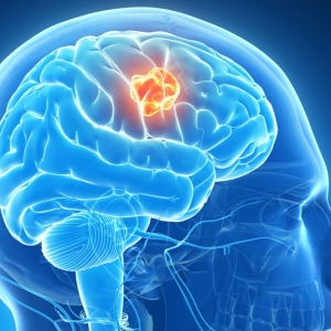 O que é um acidente vascular cerebral?