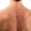 Spots iz akne na hrbtni strani, kako se znebiti