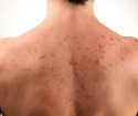 Manchas de acne nas costas Como se livrar