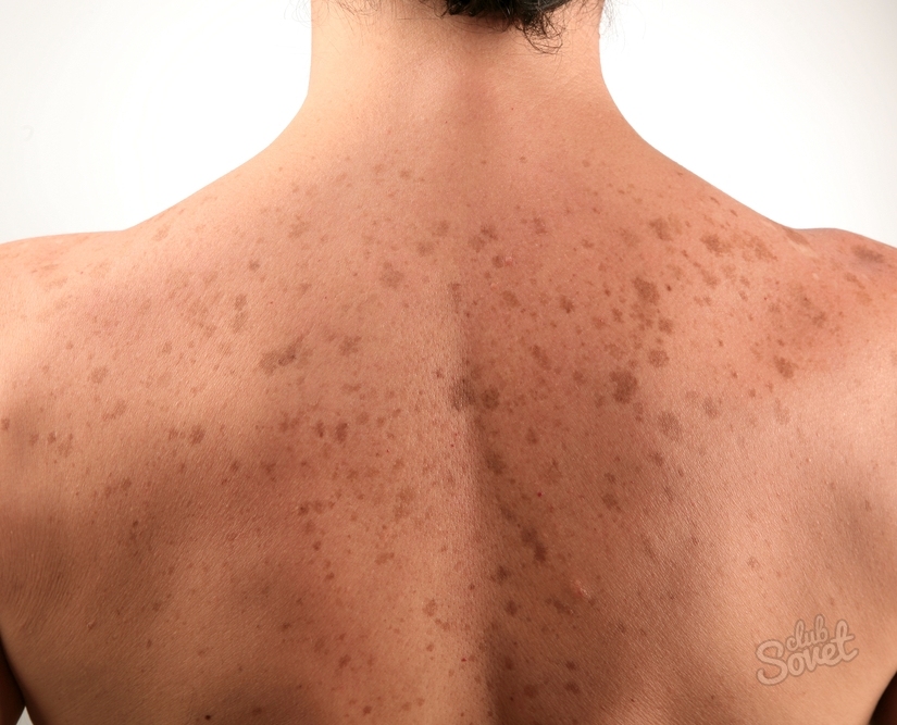 Spots d'acné à l'arrière comment se débarrasser