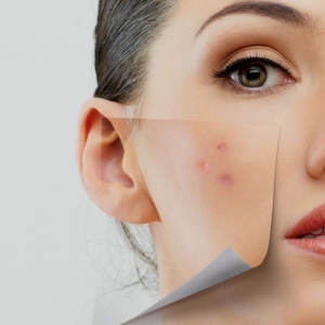 Stock Foto Inner pimples how to get rid of