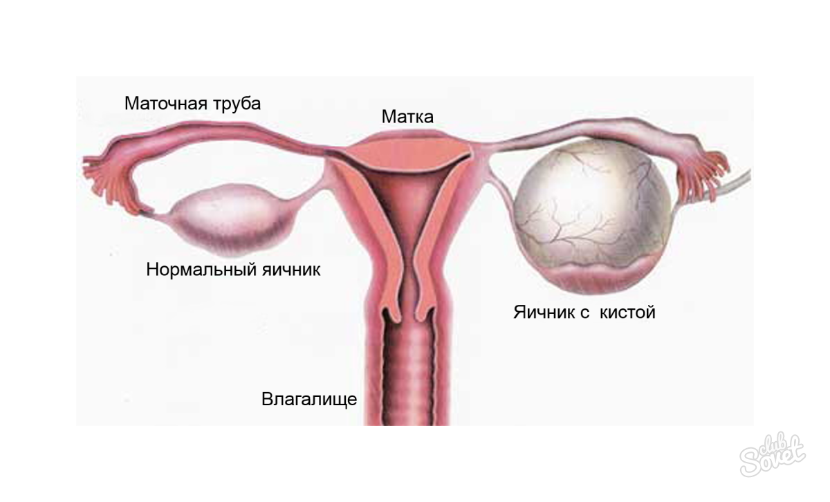 Come rimuovere la cisti ovarica