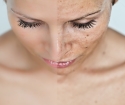Como se livrar dos pontos após a acne
