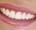 So entfernen Sie die Lücke zwischen den Zähnen