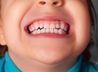 Скільки молочних зубів у дітей