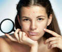 How to get rid of acne quickly