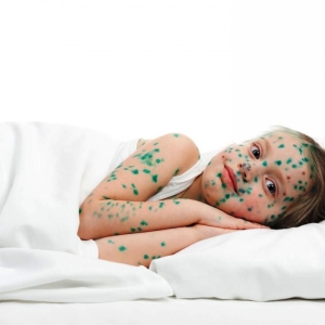 Foto Como tratar a varicela em crianças