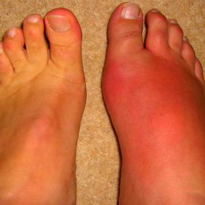 Elendy Fußentzündung - Symptome und Behandlung
