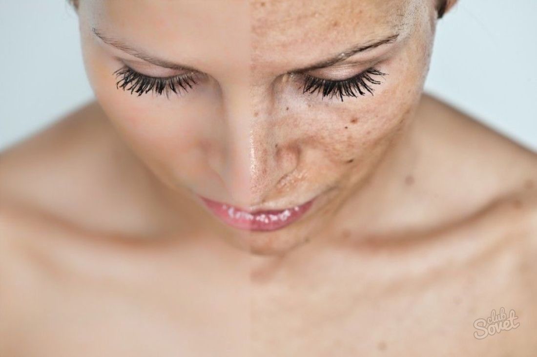 Cum să vă curățați fața de pe spoturile de pigment