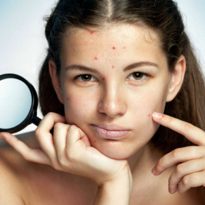 Como se livrar da acne rapidamente