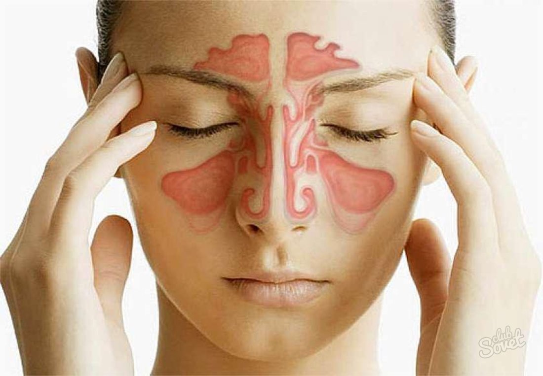 Wie man Sinusitis bestimmt