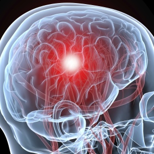 Stock Foto Causes and prevention of brain stroke