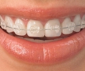 როგორ ფუნჯი კბილები braces