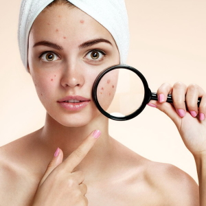 Photo Comment se débarrasser de l'acné sous-cutanée