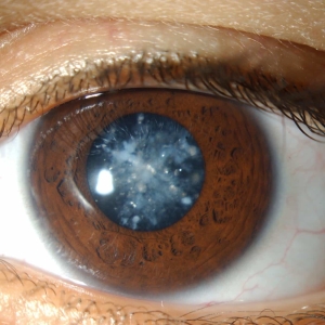 O que é glaucoma
