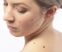 Πώς να αφαιρέσετε moles από το πρόσωπο