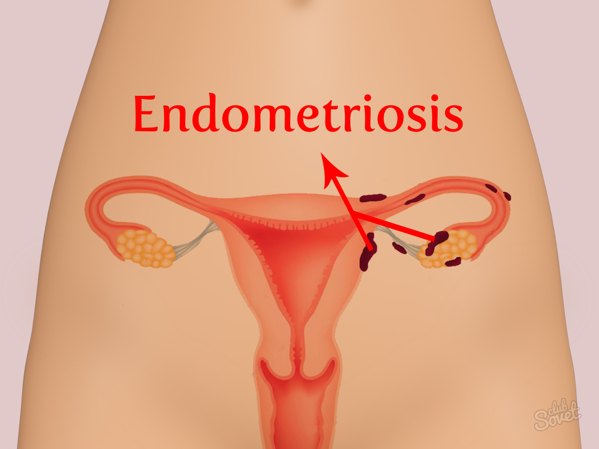 Jak léčit endometriózu
