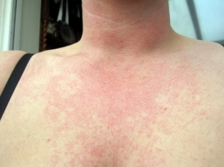 Come appare un'allergia