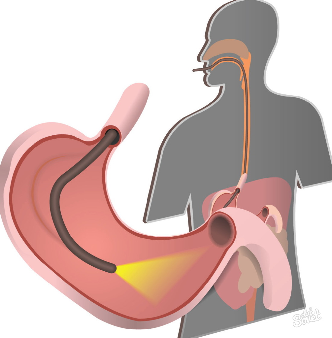 Kako se pripraviti na želodčno gastroskopijo