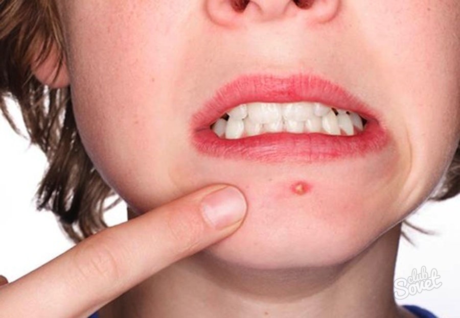 Comment traiter l'acné