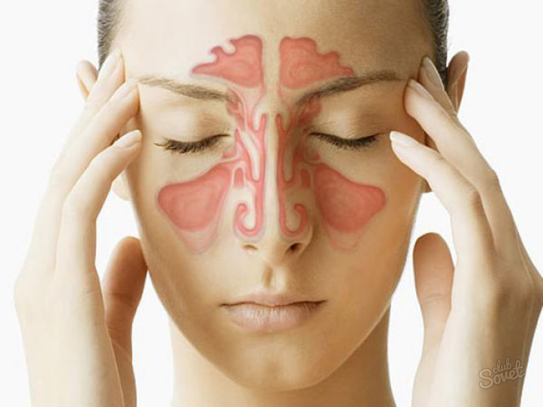 Wie man Sinusitis zu Hause heilt